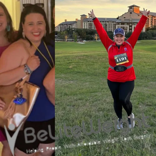 Weight Loss Surgery Before And After